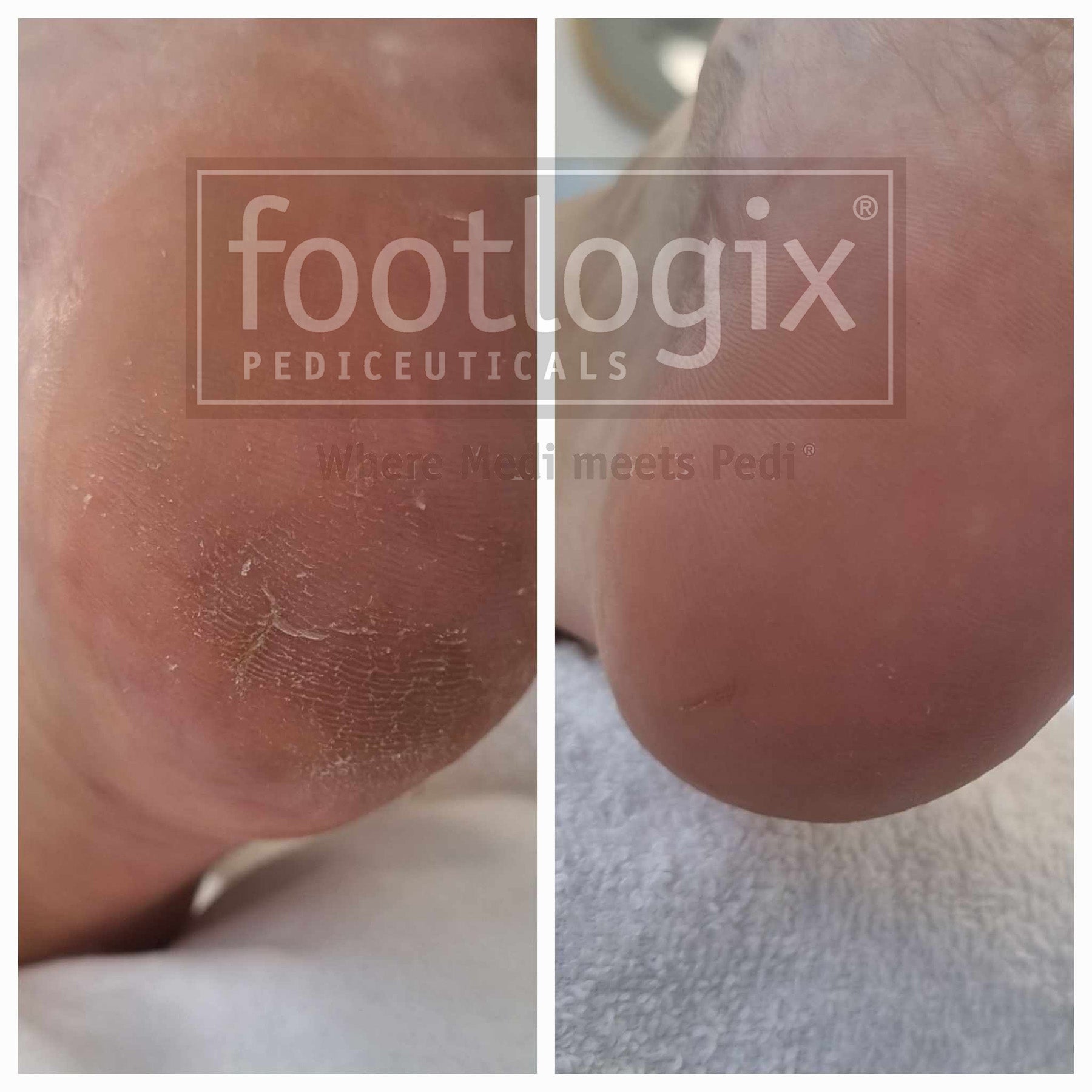 Footlogix - In Home Pedicure Combo